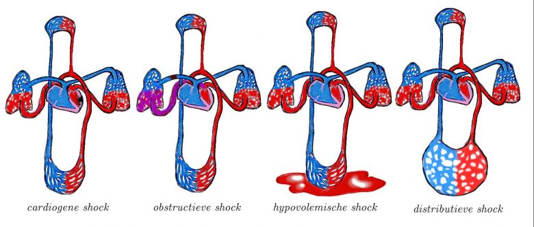 circulatieshock